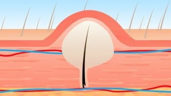 How To Prevent Ingrown Hairs After Waxing
